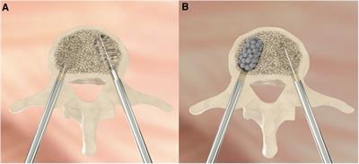 Porous titanium microsphere kyphoplasty for augmentation treatment of osteoporotic vertebral fractures: Technical report and case series